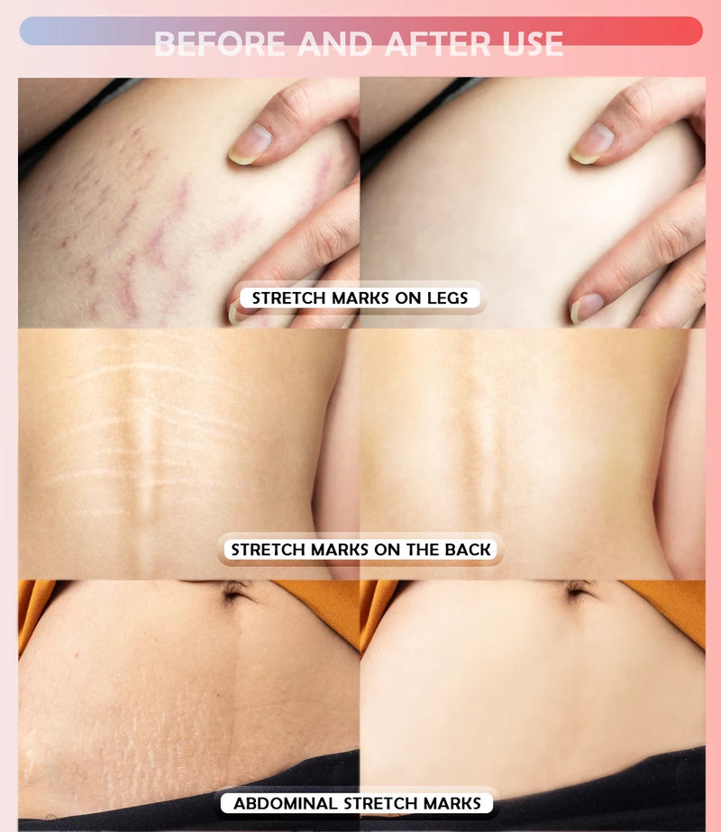 Stretch Marks Removal Matting Cream